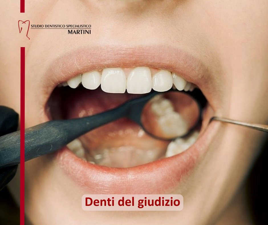 Denti del giudizio: quando è necessaria l'estrazione?