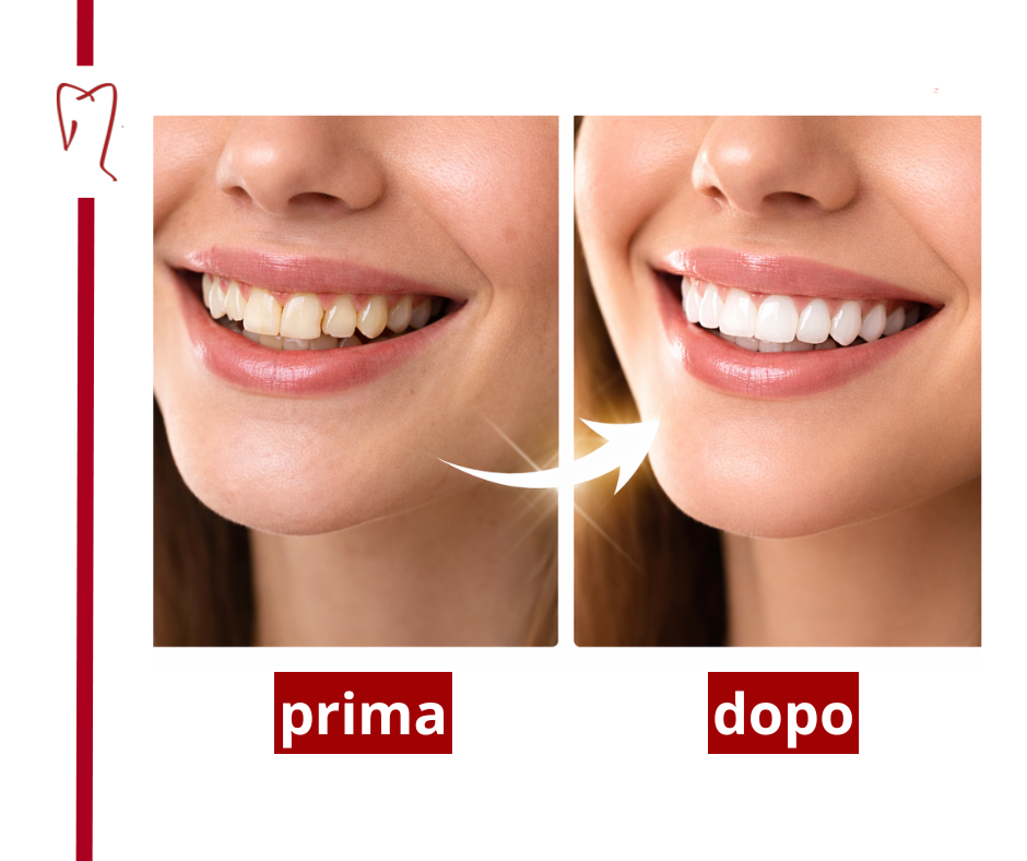 Faccette dentali: il sorriso naturale che desideri