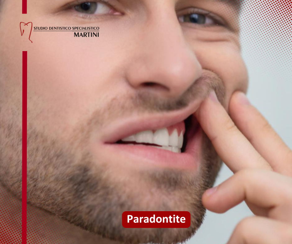 Paradontite: cos'è e quali sono i sintomi